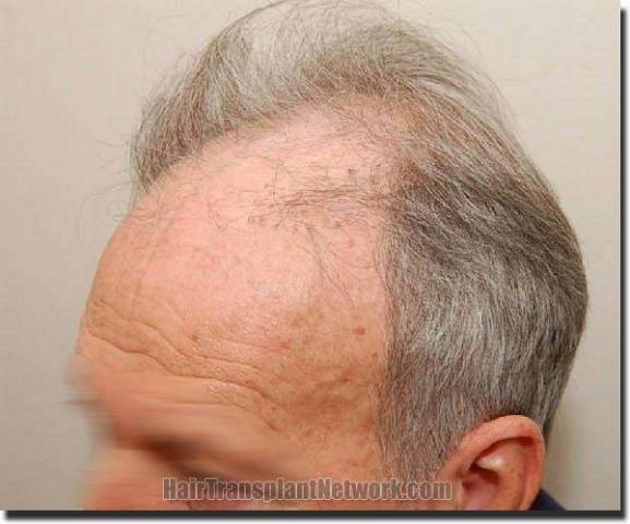 Hair restoration procedure results