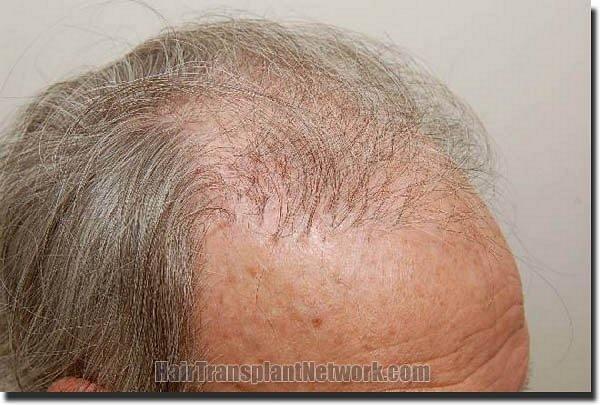 Hair restoration procedure results