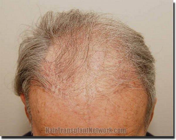 Hair restoration procedure results