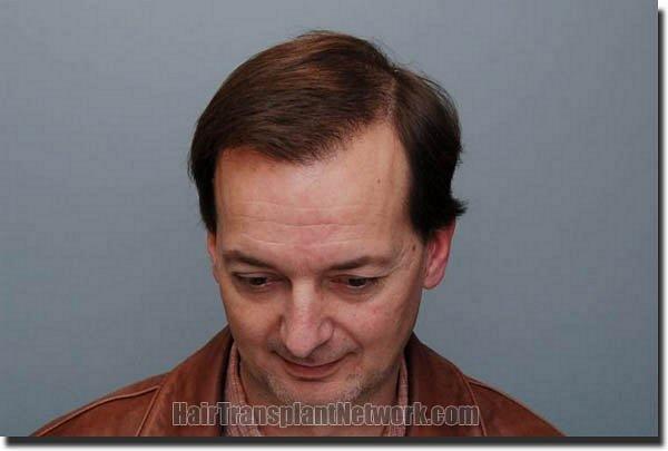 Hair restoration procedure results