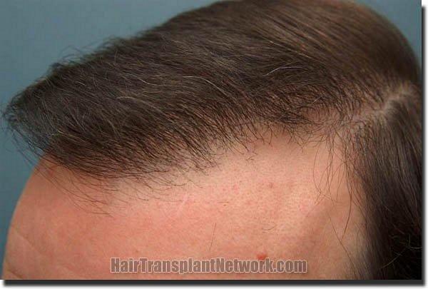 Hair restoration procedure results