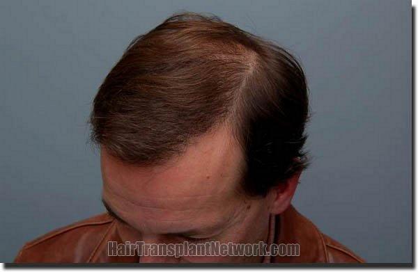 Hair restoration procedure results