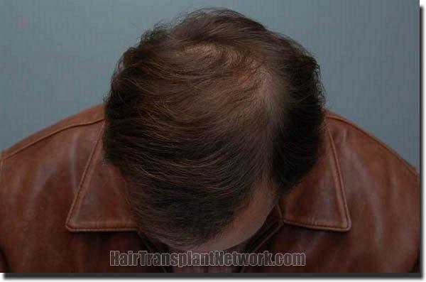 Hair restoration procedure results