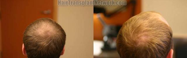 Hair restoration procedure before and after pictures