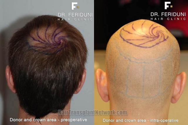 Hair transplantation surgery before and after photos