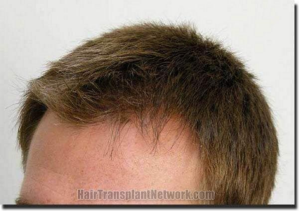 Hair restoration procedure results