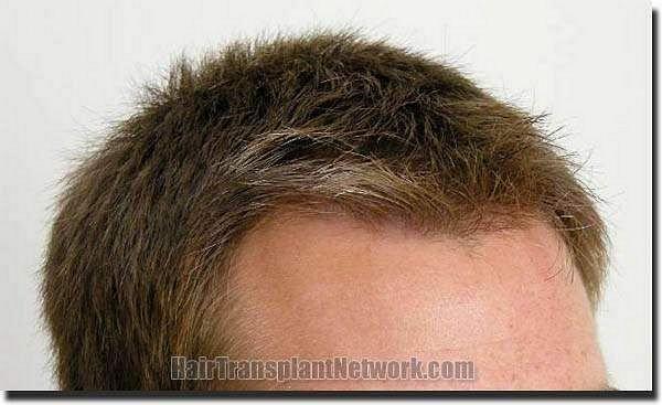 Hair restoration procedure results