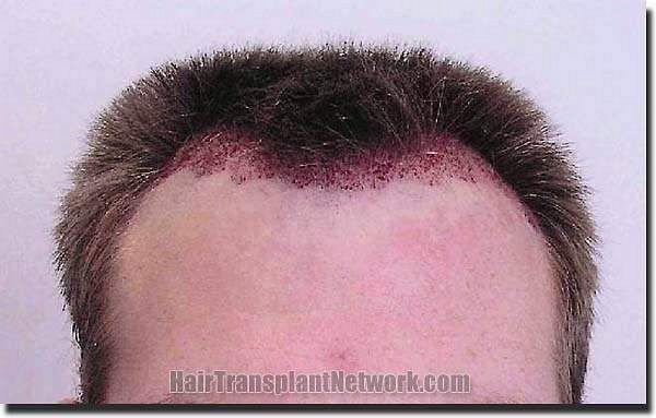 Hair restoration procedure results