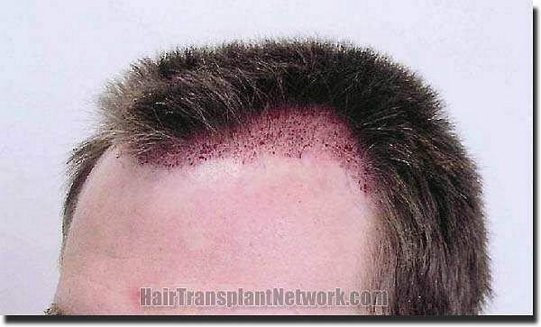 Hair restoration procedure results