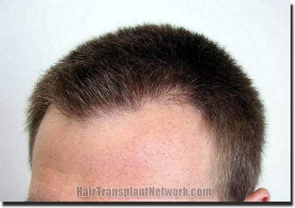 Hair restoration procedure results