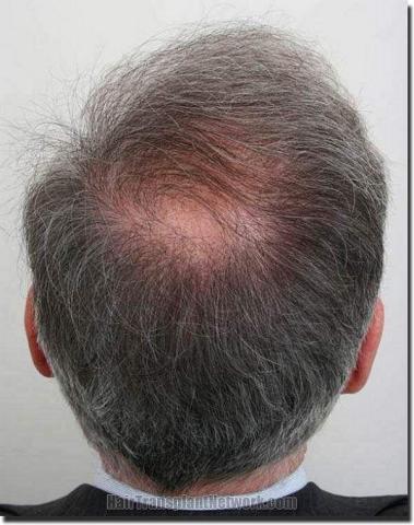 Hair restoration procedure results