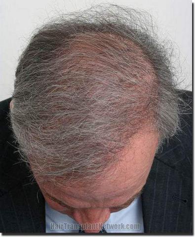 Hair restoration procedure results