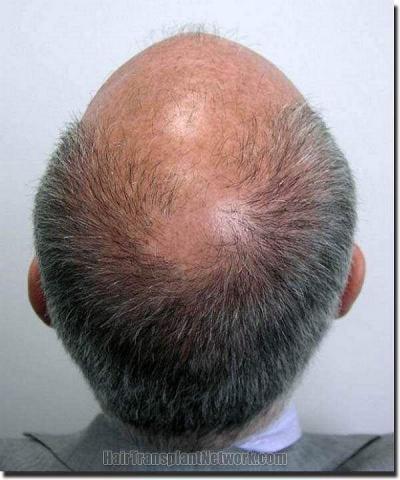 Hair restoration procedure results