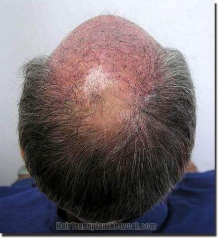 Hair restoration procedure results