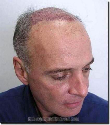 Hair restoration procedure results