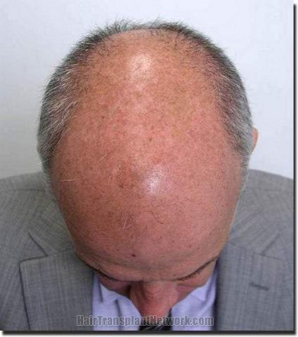 Hair restoration procedure results