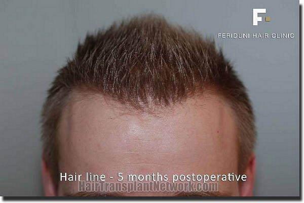 Hair restoration procedure results