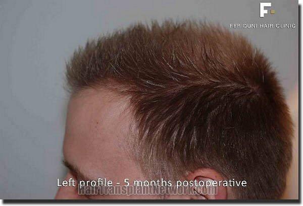 Hair restoration procedure results