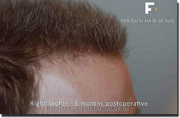 Hair restoration procedure results