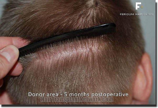 Hair restoration procedure results