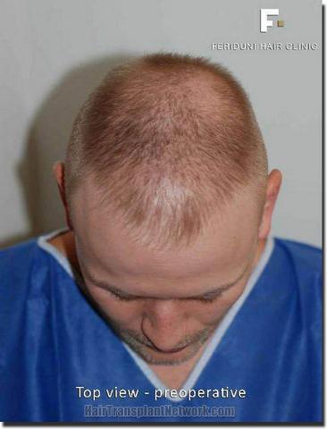 Hair restoration procedure results