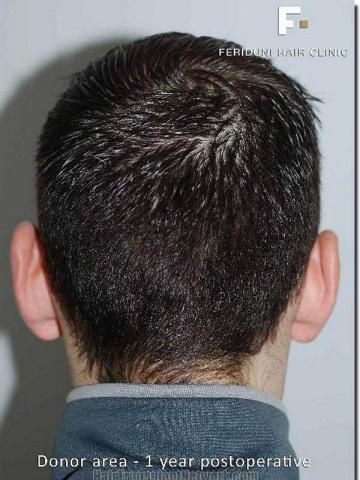 Hair restoration procedure results