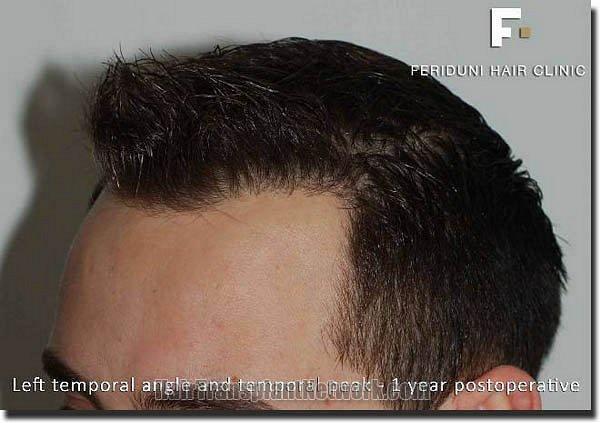 Hair restoration procedure results