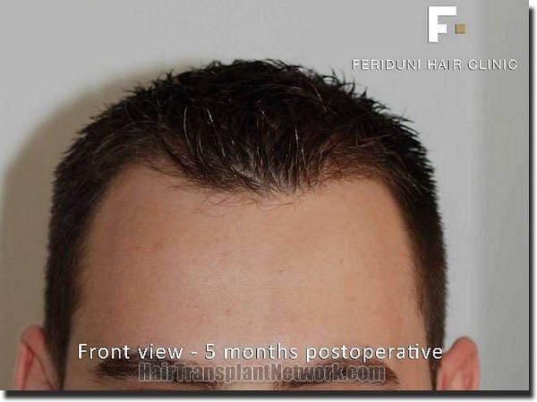 Hair restoration procedure results