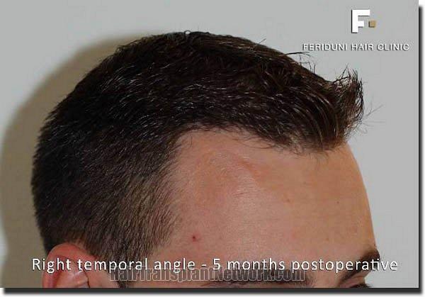 Hair restoration procedure results