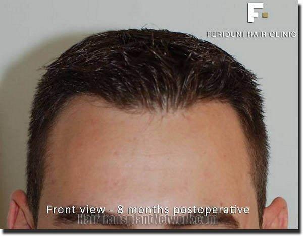 Hair restoration procedure results