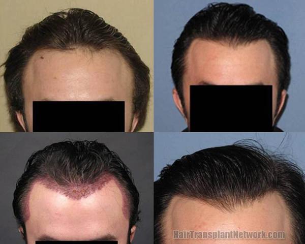 Front view before and after hair transplant
