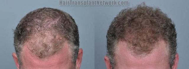 Hair restoration procedure before and after results