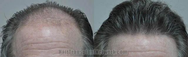 Hair restoration procedure before and after results