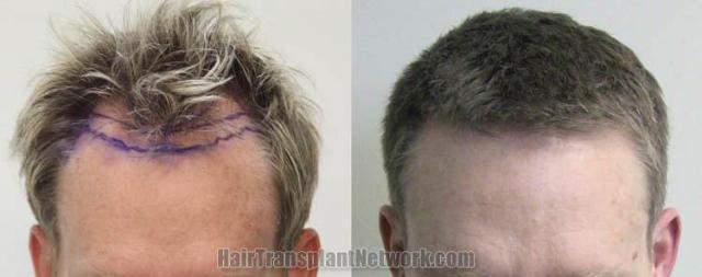 Hair restoration procedure before and after results