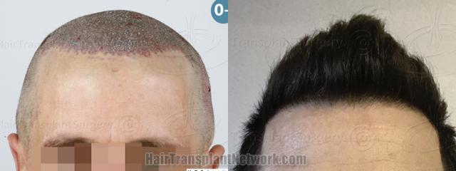  before and after result photographs