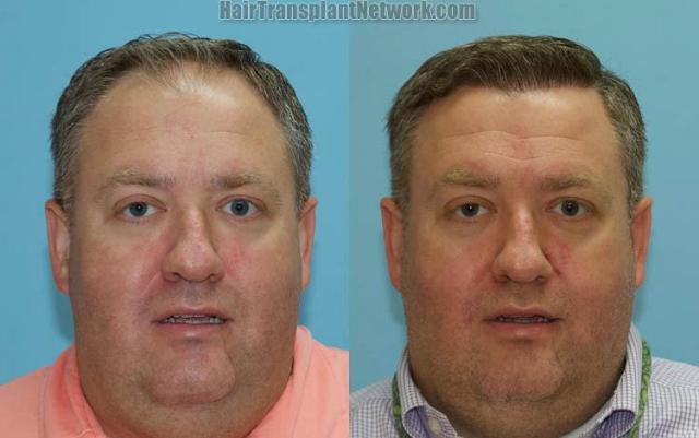 Front view - Before and after hair restoration procedure