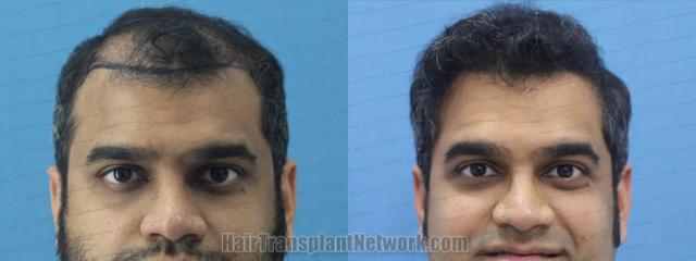   before and after result photographs