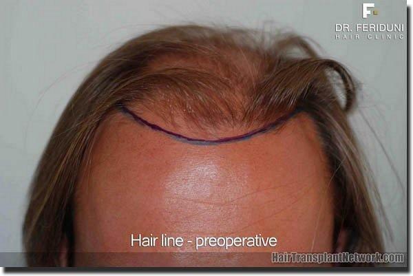 Hair restoration procedure results