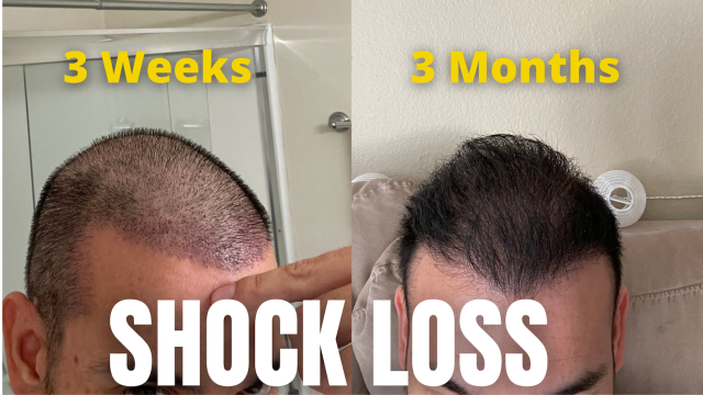Hair Transplant Case Study with 3203 Scalp Grafts in a 44 year old patient  | Hair Transplant Case Study