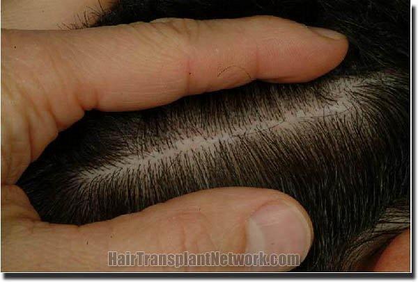 Hair restoration procedure results