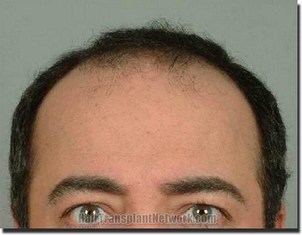 Hair restoration procedure results