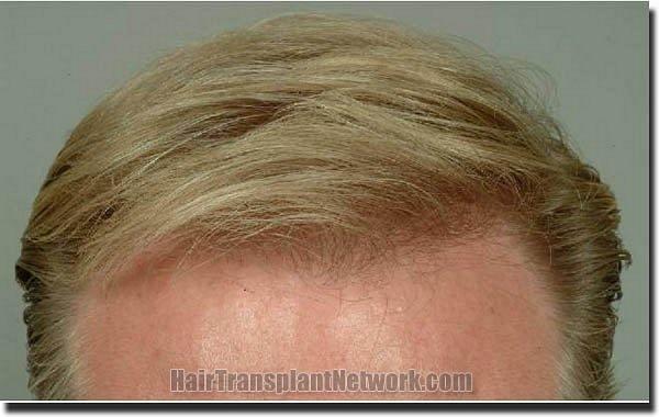 Hair restoration procedure results