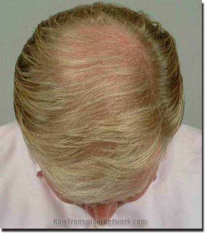 Hair restoration procedure results