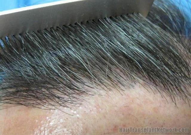 Hair restoration hairline closeup