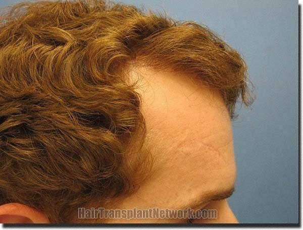 Hair restoration procedure results