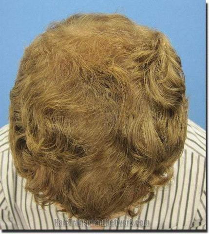 Hair restoration procedure results