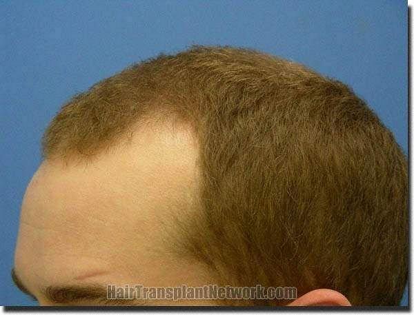 Hair restoration procedure results