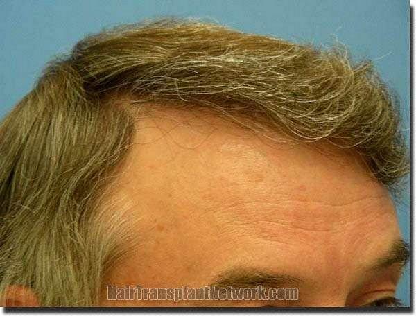 Hair restoration procedure results