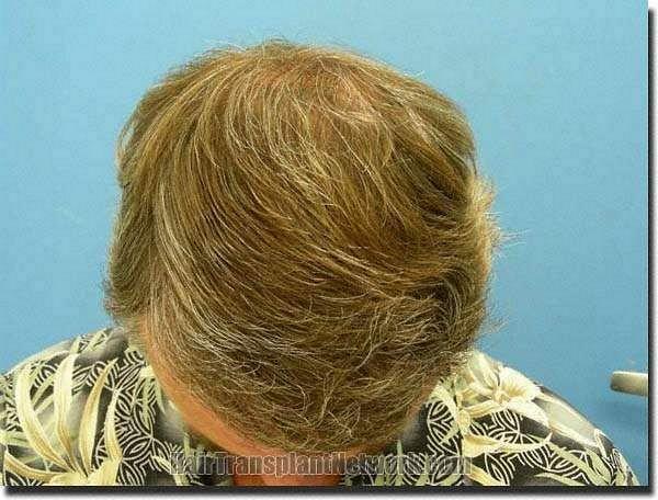 Hair restoration procedure results