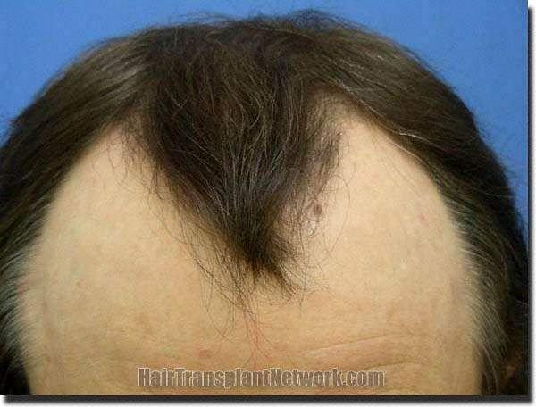 Hair restoration procedure results